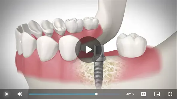 Dental implants video